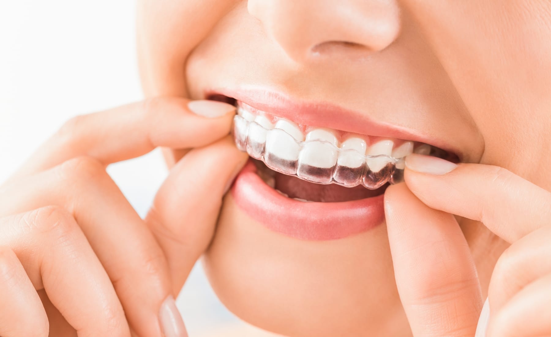 Invisalign - Dentisterie esthétique - CDBPA